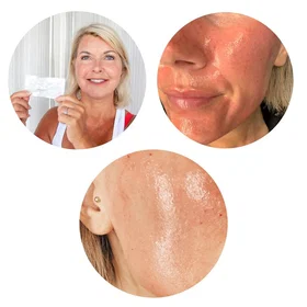 TrendRehab MicroneedlingPen